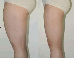 腿部抽脂视频,术前术后注意事项与效果展示